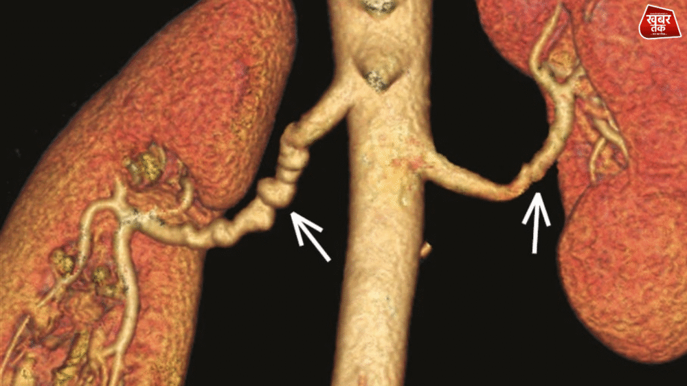 Renal Hypertension
